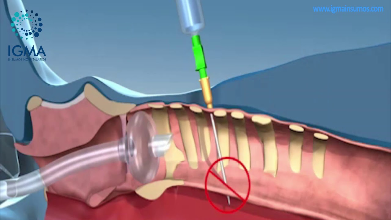 ¿ Cómo se realiza una traqueostomía percutánea?