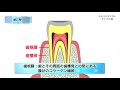 歯根膜炎／ミルメディカル 家庭の医学 動画版