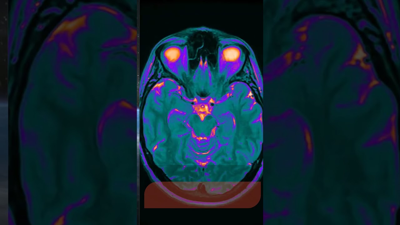 Spaceflight Changes the Shape of the Human Brain