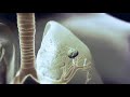 Tuberculosis (TB): Transmission and Pathogenesis