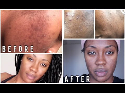 *Updated* Skin Care Routine How to get Rid of Acne & Dark Spots