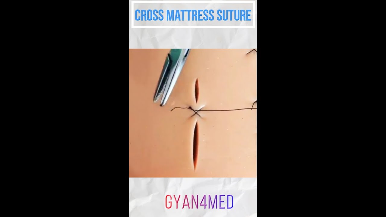Cross Mattress Suture Technique | Cruciate suture pattern