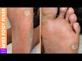 DARK CALLUS AND DRY SKIN REMOVAL BY MISS FOOT FIXER Marion Yau