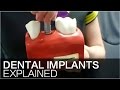 How do implants work