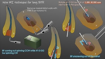 Minimally invasive removal of a long broken file without using a loop/ループを使用しない長い破折器具除去