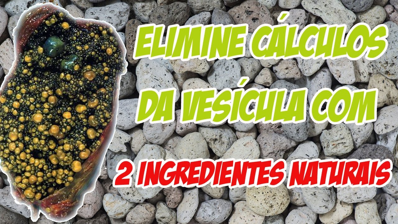 naturopatia medicina natural Elime Cálculos da Vesícula com Apenas 2 Ingredientes