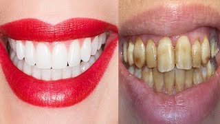 Ela MISTUROU 2 INGREDIENTES e PASSOU nos DENTES  Resultado DENTES BRANQUÃSSIMOS ESPELHADOS