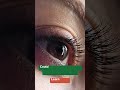 What Is Low Vision? Caleb's Guess from Denver