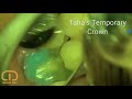 Taha&#39;s Temporary Crown Technique