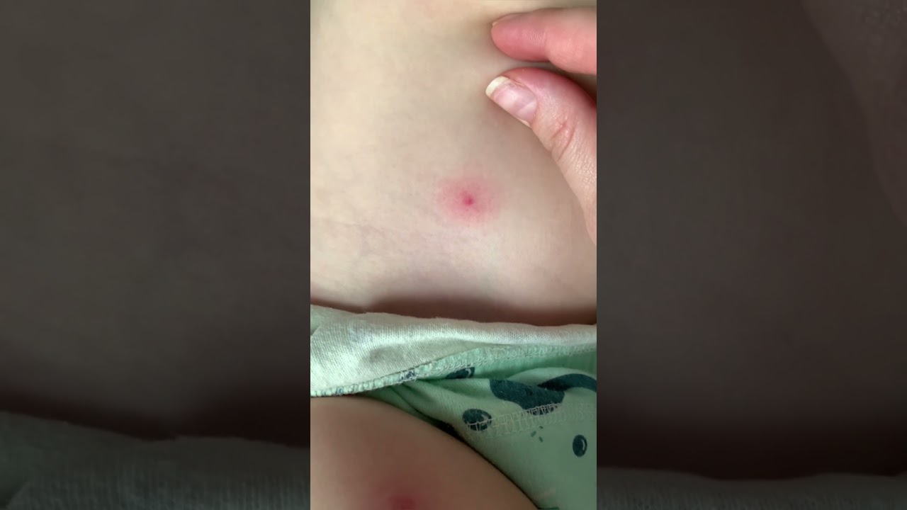 Как выглядят укусы клопов на теле ребенка