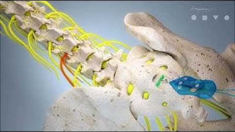 Neuroplasty  CPT code - simplify medical coding