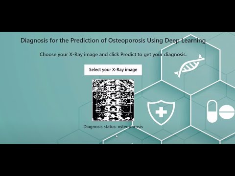 Osteoporosis Disease Detection | CNN | Deep Learning | Machine Learning ...