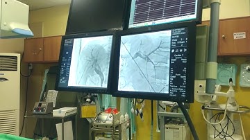 percutaneous STRICTUROPLASTY  following PTBD