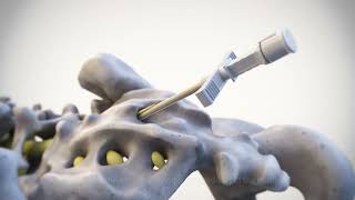 FORA -B (Steerable Epidural Balloon Catheter)