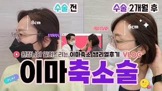 모발이식 대신 의사가 직접해 본 이마축소술 수술 후 브이로그 1편💜(고유성형외과 조건 원장)