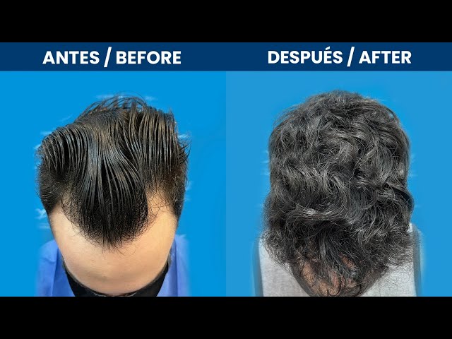 Injerto Capilar Barcelona 2072 folículos (5555 pelos)