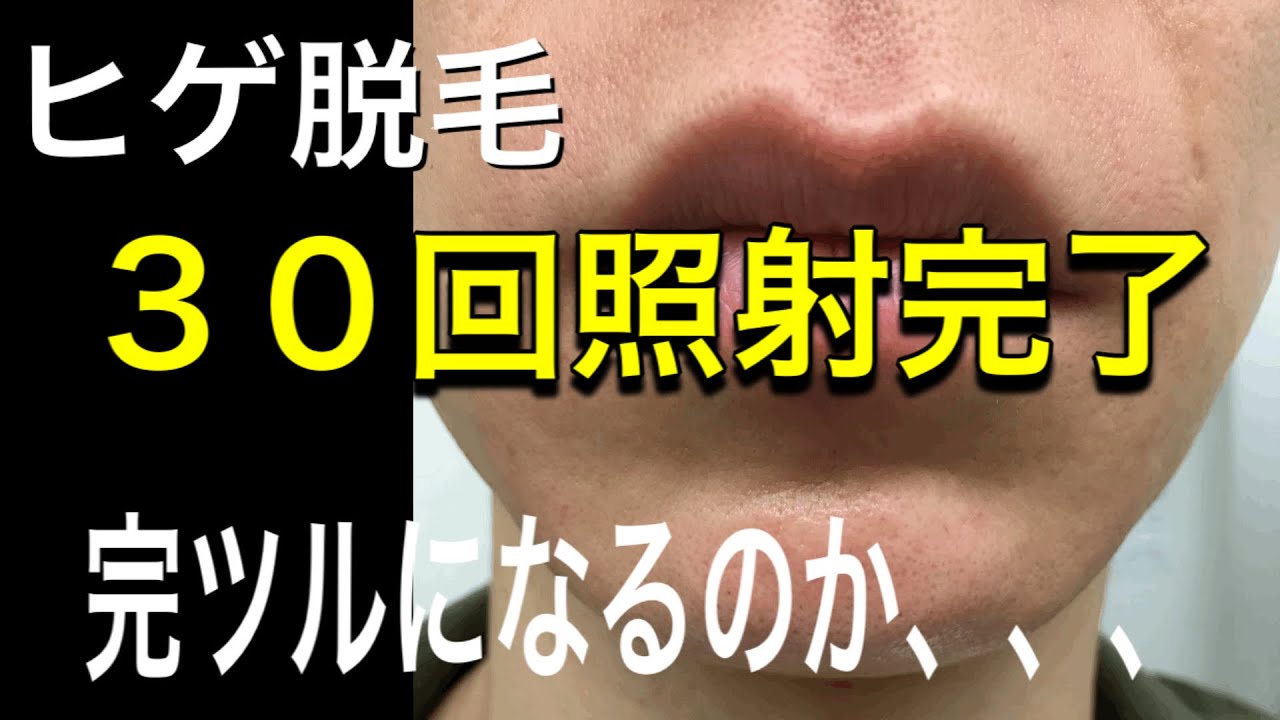 目指せ完ツル ヒゲ脱毛30回照射してきました 完ツルになるのか Youtube 目指せ完ツル ヒゲ脱毛30回照射してきました 完ツルになるのか Youtube