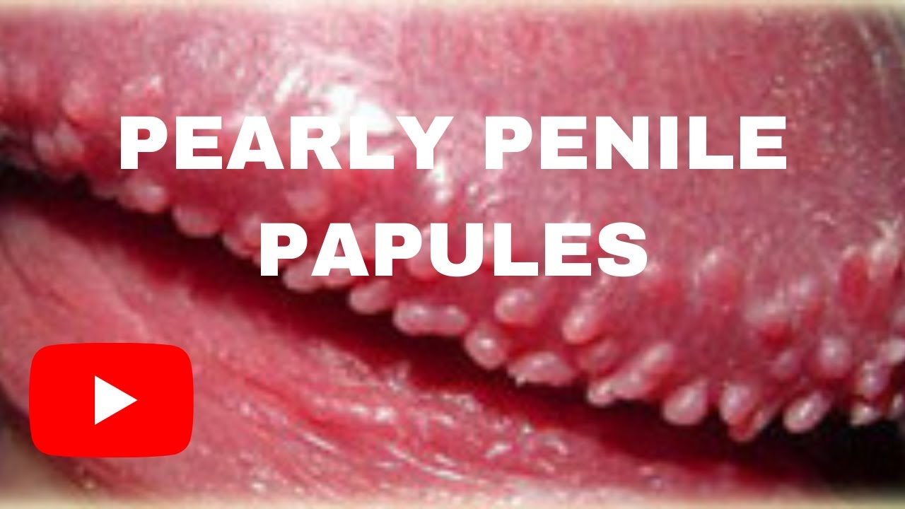 PEARLY PENILE PAPULES- Men's Problem - YouTube.