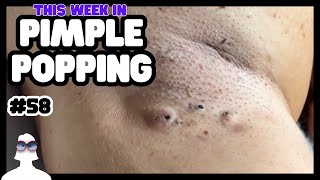 Download lagu This Week In PIMPLE POPPING #58