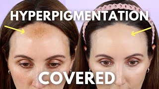 How to Conceal Your Hyperpigmentation & Dark Spots screenshot 3