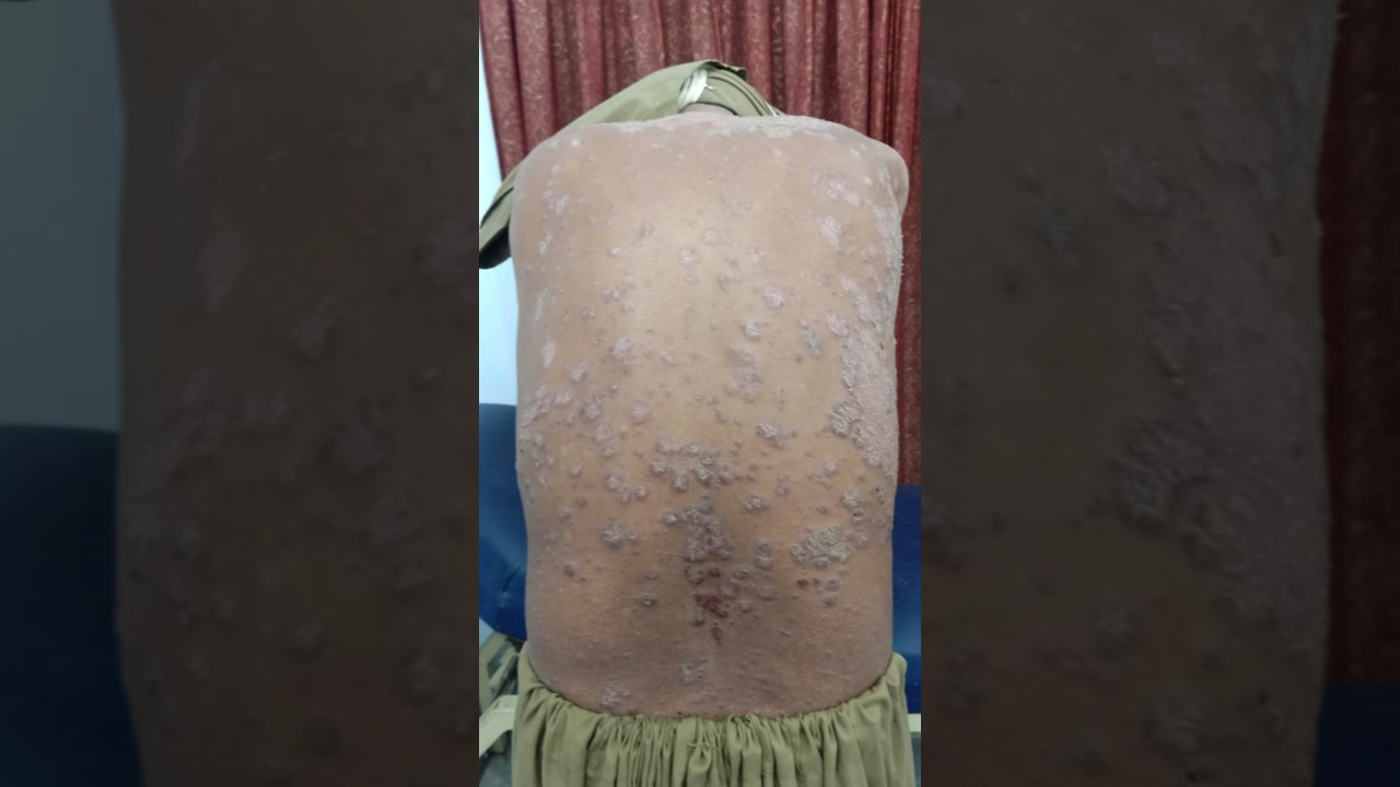 Psoriasis on back | #psoriasis #psoriasiscure #psoriasistreatment #psoriasissolution #shorts