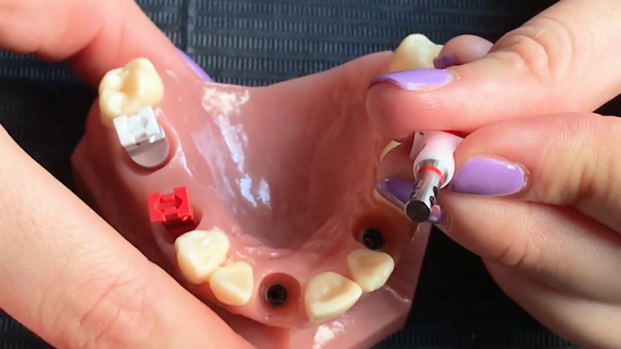 Tutorial Actualización en tomas de impresión en SynOcta