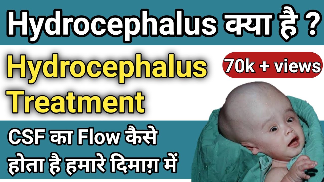hydrocephalus-in-hindi-hydrocephalus-types-and-treatment-in-hindi