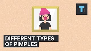 The many different types of pimples, and how to treat each one