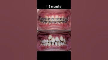 Quá Trình Di Chuyển Của Răng Khi Niềng | Dr Cường Official