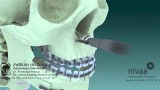 Cirurgia Ortognática Bimaxilar