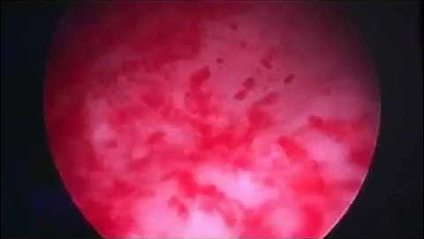 Interstitial cystitis - cystoscopic view of the bladder
