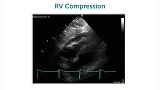 What is cardiac tamponade?