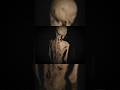 His muscles turned into BONE ☠️ (The Stone Man) #shorts #medical #scary