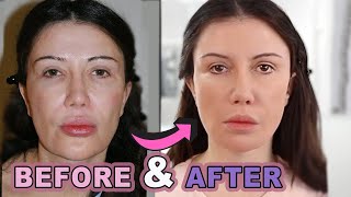 My Face Lift Before and After: Part 2