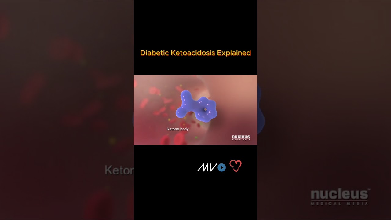 Diabetic Ketoacidosis: A Dangerous Diabetes Emergency Explained! Diabetic Ketoacidosis: A Dangerous Diabetes Emergency Explained!
