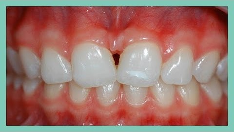 Non-ortho solution for diastema and tilted maxillary incisors