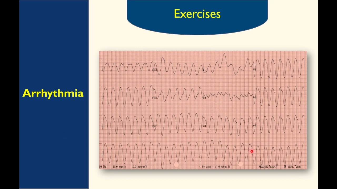شرح تخطيط القلب (ECG) - الحلقة الثالثة (Arrhythmia)