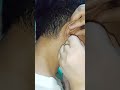 HOW TO REMOVE COTTON FROM EAR