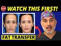Facial Fat Transfer 101 Everything You Need To Know About Getting A Fat Transfer To The Face Facial Fat Transfer 101 Everything You Need To Know About Getting A Fat Transfer To The Face