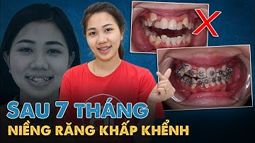 KẾT QUẢ NIỀNG RĂNG KHẤP KHỂNH SAU 7 THÁNG TẠI LẠC VIỆT INTECH