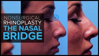 Non Surgical Rhinoplasty: Contouring the Nasal Bridge With Dermal Fillers at Mabrie Facial Institute