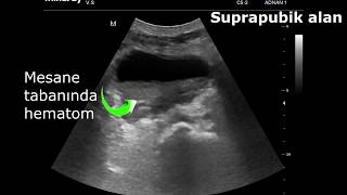 Gis Perforasyonu- Peritonit Ayırımında Yatakbaşı Ultrasononografi