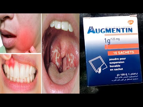 مضاد حيوي لعلاج التهاب اللوزتين و تعفنات الفم وانتفاخ اللثة 