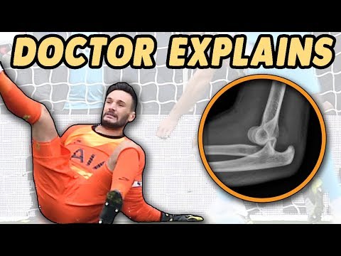Doctor's Guide to Hugo Lloris Elbow Dislocation
