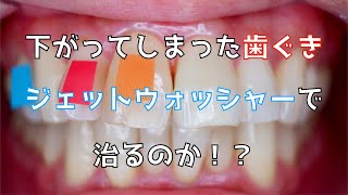 下がってしまった歯ぐきはジェットウォッシャーで治るのか【新企画スタート】