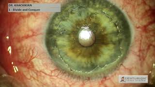 Epithelial Basement Membrane Dystrophy