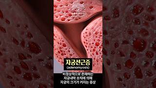 #자궁선근증 #자궁근종 너무 심해서 여성호르몬제를 못써요!