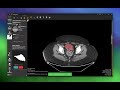 SAM2 Tumor Segmentation in DICOM Vision: AI-Assisted Annotation for Rare Tumors