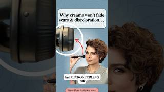 Why Creams Can’t Fade Scars… but At-Home Microneedling Can ✨ (Better Than Costly RF)