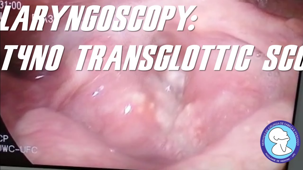 LARYNGOSCOPY T4aN0 SUPRAGLOTTIC AND GLOTTIC SQUAMOUS CELL CARCINOMA
